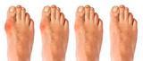 The Bunion Relief and Forefoot Protector Brace "Pair"